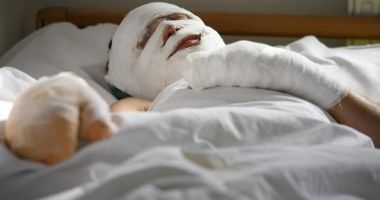 Pacienții cu arsuri grave vor putea fi tratați în Belgia