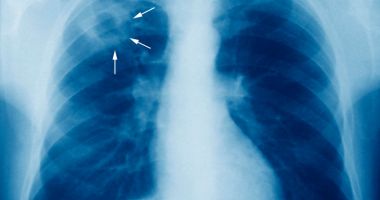 Stire din Actualitate : Tuberculoza poate fi transmisă printr-o simplă respirație