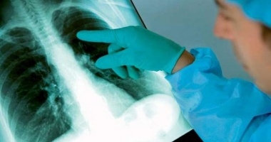 Stire din Sănătate : Cazurile de deces din cauza tuberculozei, în scădere. Coinfecțiile cu HIV, în creștere