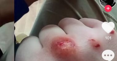Stire din Eveniment : ATENŢIE, IMAGINI CU IMPACT EMOŢIONAL! "Moneda rusească", joc periculos printre elevi. Medic: "Infecția poate să ajungă la nivelul oaselor"
