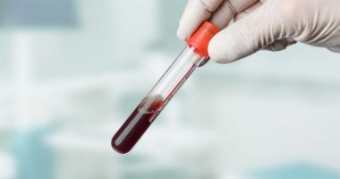 Stire din Sănătate : Urinarea cu sânge este produsă de diferite infecţii sau inflamaţii