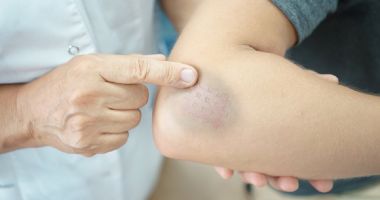 Cum scăpați în doi timp și trei mișcări de vânătăi