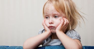 Stire din Sănătate : Varicela debutează cu simptome de răceală. Bubițele apar mai târziu
