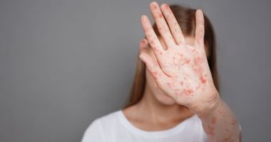 Stire din Sănătate : Virusul varicelei se poate reactiva la maturitate