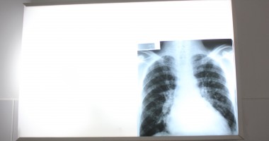 Stire din Sănătate : Iată unde puteți afla informații despre tuberculoză