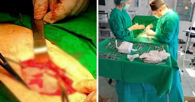 Stire din Social : Caz medical rar operat cu succes la Spitalul Orășenesc Hârșova