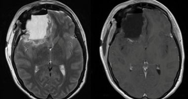 Stire din Actualitate : Peste 100 de absolvenți ai aceluiași liceu au făcut o formă rară de cancer cerebral. Ce arată ancheta