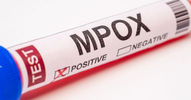 Stire din Actualitate : Marea Britanie anunţă primul caz de infectare cu noua variantă de mpox