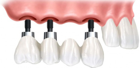 Când se recomandă implant dentar? - 2octmediculimplantdentar-1349187643.jpg