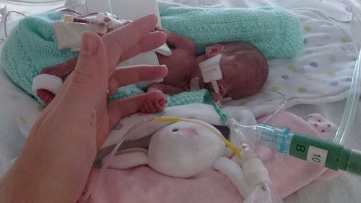 Fetița cât o palmă s-a născut cu 4 luni înainte de termen. 10 chirurgi au operat-o de urgență - 3500fetita000067103900-1488455898.jpg