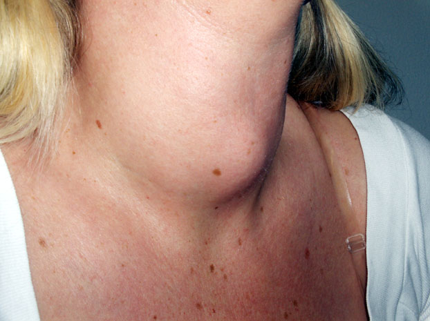 Cancerul tiroidian, o boală care afectează în special femeile - 77c80d023cdbb58b03fa8367b709d52f.jpg