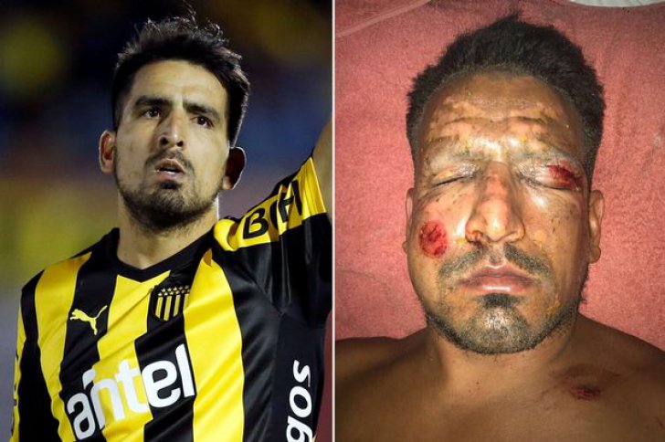 Un fotbalist de top a suferit arsuri grave la față de la artificii - accidentlucasviatri37260800-1514968096.jpg