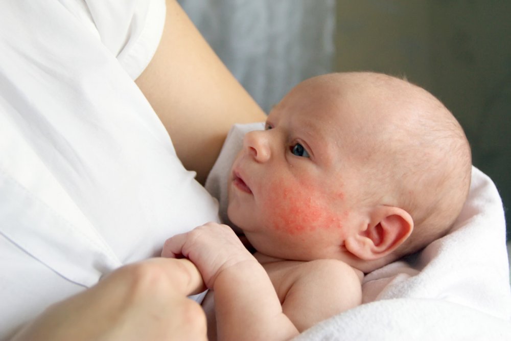 Acneea la bebeluși dispare, deseori, de la sine, fără tratament - acnee1-1659445949.jpg