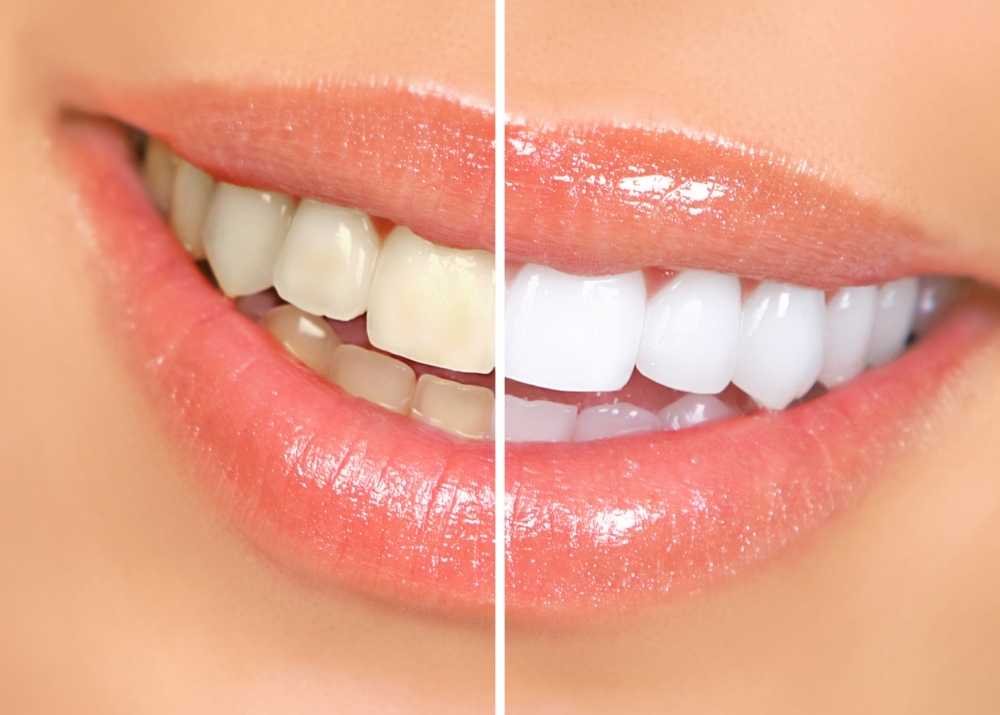 Albirea dinților cu ajutorul produselor naturiste - albiredinti-1413985214.jpg