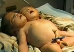 Video | Bebeluș cu două capete născut în India - b8347d87b31c91b1d40aabd0fb298f1d.jpg