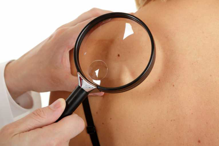 Consultații gratuite la dermatolog, la CONSTANȚA - cancerpiele1335882598-1400842496.jpg