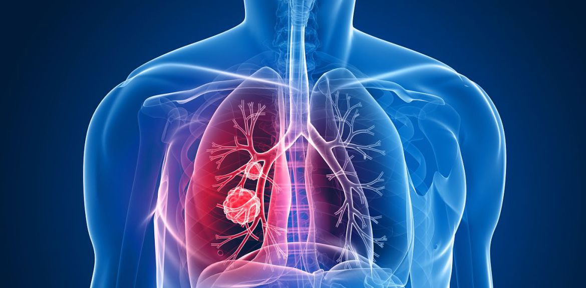 Creşterea cazurilor de cancer pulmonar la nefumători, legată de un gaz radioactiv din aer - cancerpulmonar-1713109664.jpg