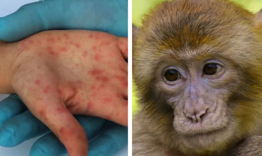 România se pregătește de ce e mai rău în privința variolei maimuței: INPS are deja o metodologie pentru diagnosticarea cazurilor - clipboard011840x500-1653666444.jpg