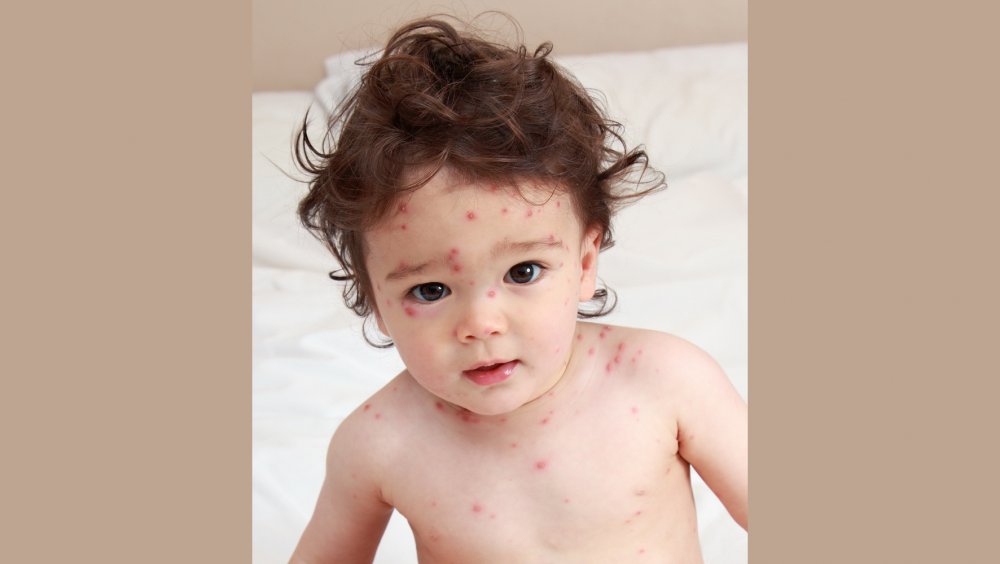 Afecţiuni ale copiilor care se manifestă cu erupţii şi febră - fondroseolainfantum2jpg1-1672152894.jpg