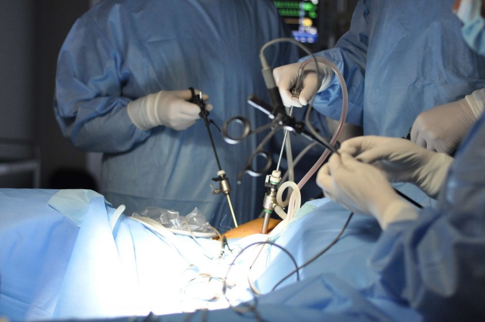 Ce avantaje au pacienții care se operează laparoscopic - laparoscopie1-1539068618.jpg