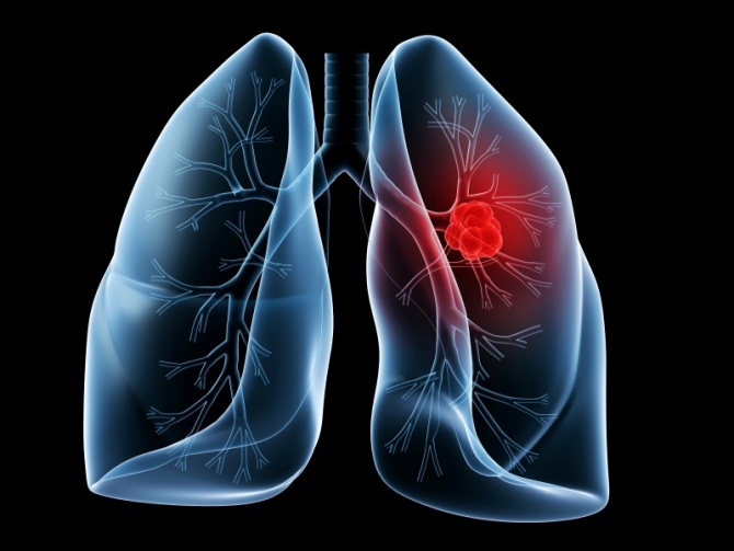 S-a descoperit alimentul ce ucide 85% din celulele cancerului pulmonar - lungcancer83729700-1439019966.jpg