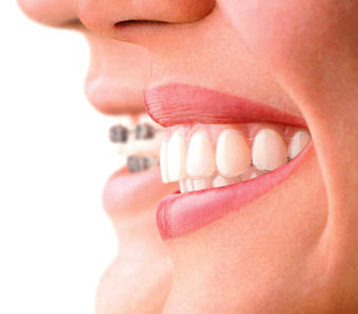 Până la ce vârstă se pot îndrepta dinții - medicpanalacevarsta-1399996052.jpg