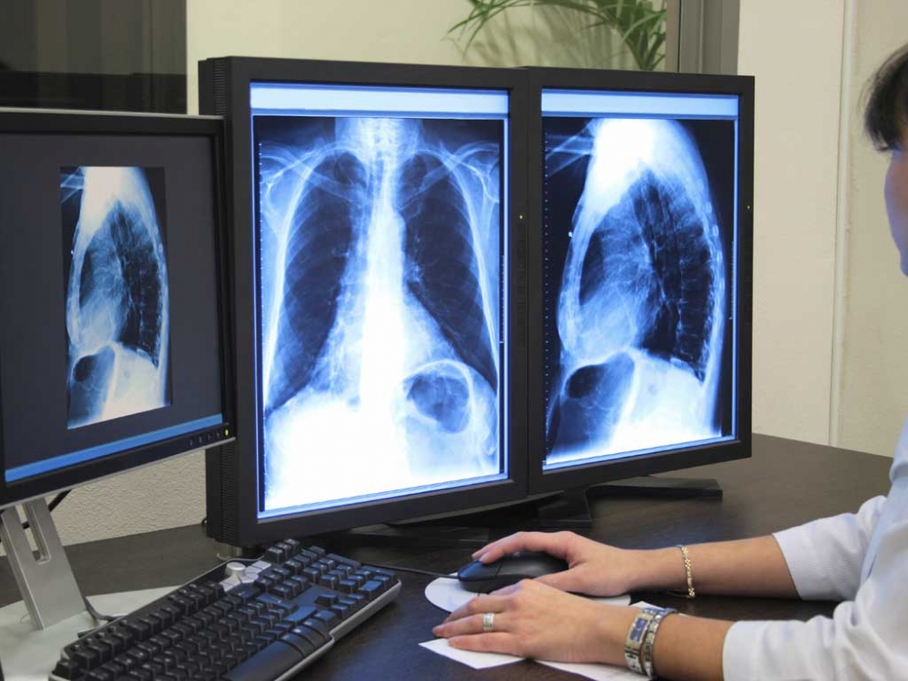 Bolnavii de cancer pulmonar au la dispoziție un ghid special - plamani1352846980-1385556184.jpg