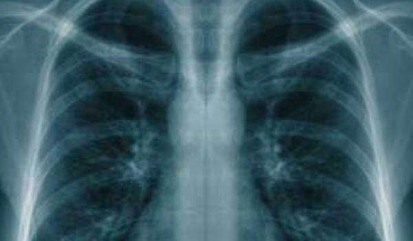 Peste jumătate din populație prezintă risc de boli pulmonare - radio-1368448764.jpg