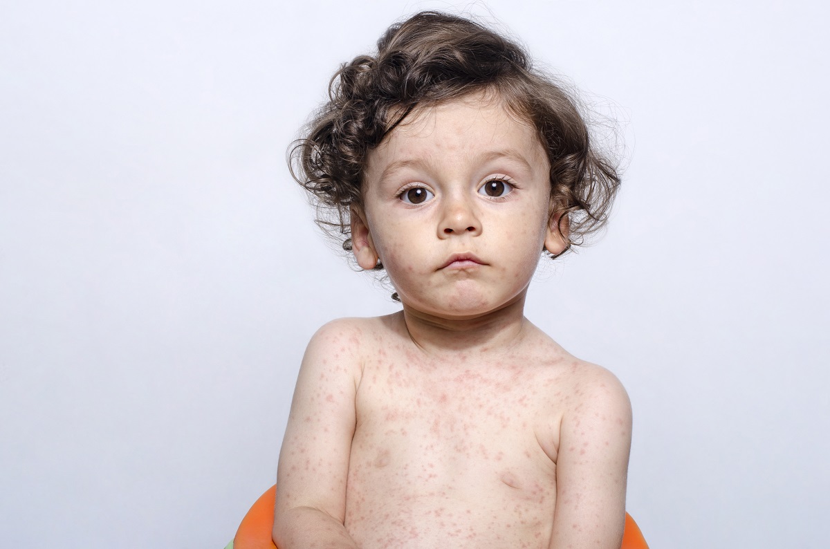 Vaccinaţi-vă copiii! Creşte numărul cazurilor de rujeolă - rujeola-1711391220.jpg