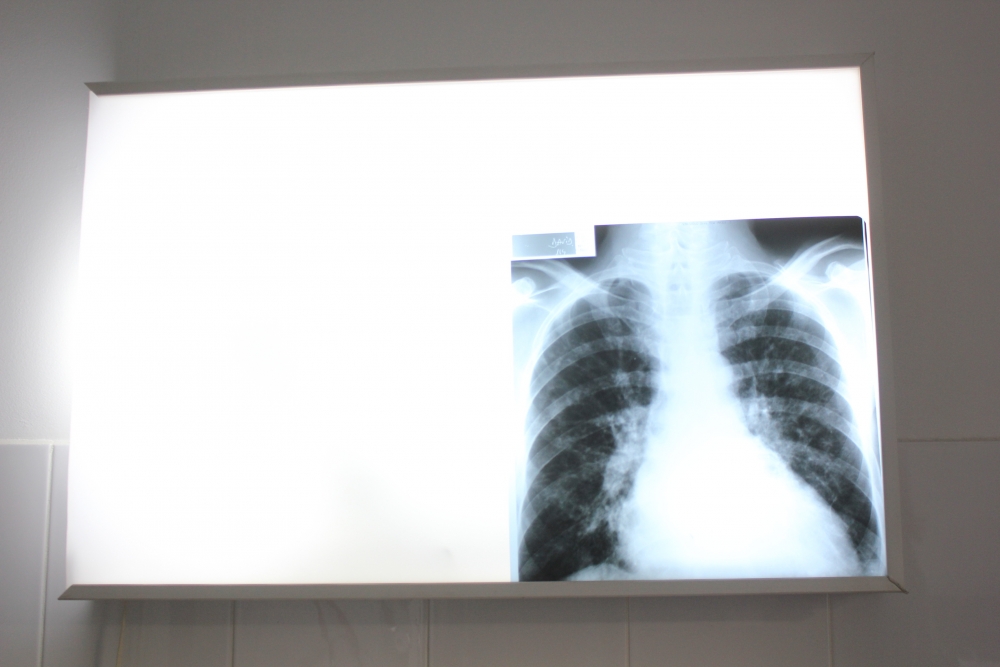 Iată unde puteți afla informații despre tuberculoză - veraenikopallpneumologradiografi-1376907489.jpg